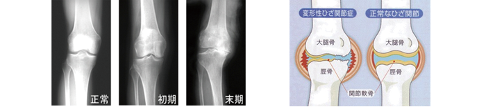 変形性膝関節症の解説画像