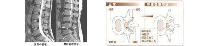 腰部脊柱管狭窄症の解説画像