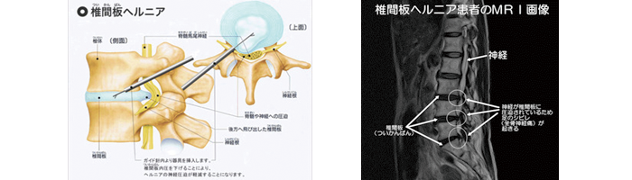 腰椎椎間板ヘルニアの解説画像